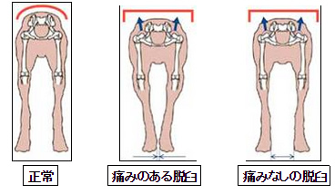 腰が幅広く平たい＜四角い腰：ボクシー・ヒップ＞